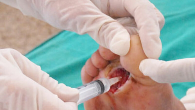 Aplicación del Heberprot-P mejora calidad de vida de cabaiguanenses con úlceras de pie diabético