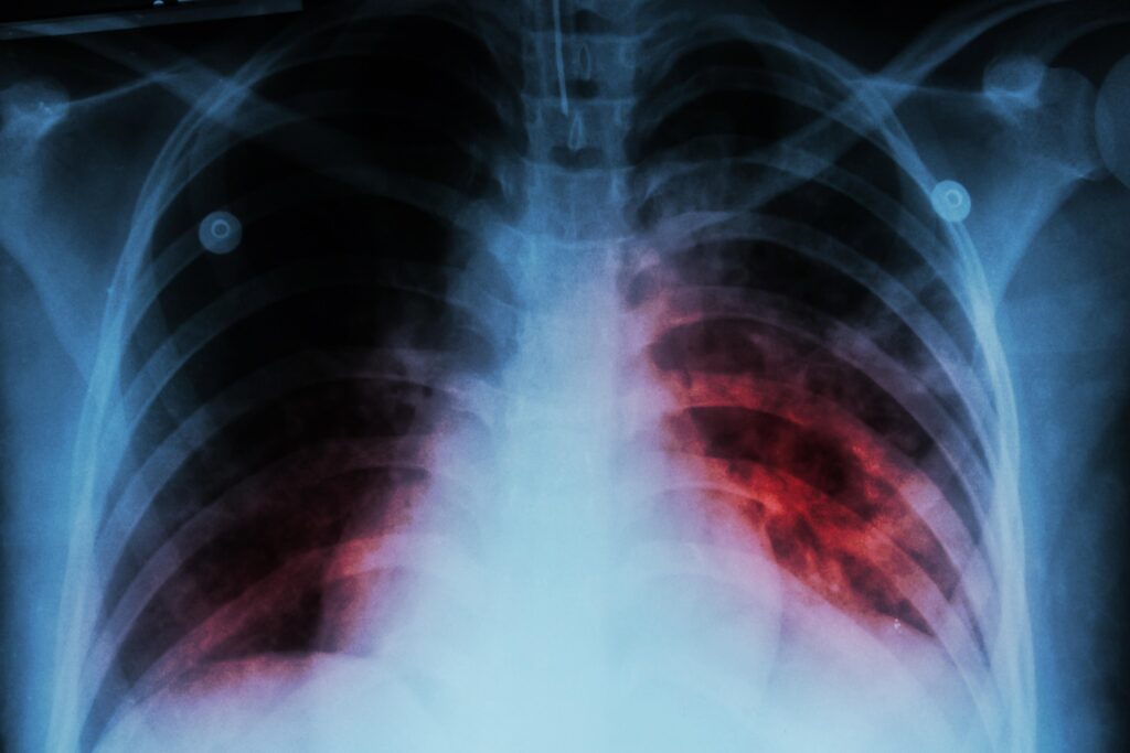 tuberculosis