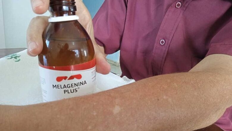 Melagenina Plus, el fármaco «milagroso» contra el vitiligo