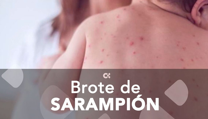 OPS emite alerta por brote de sarampión en las Américas