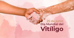 vitíligo