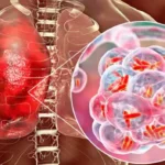 Garantizan especialistas cabaiguanenses control de la tuberculosis en el municipio (+ Audio)