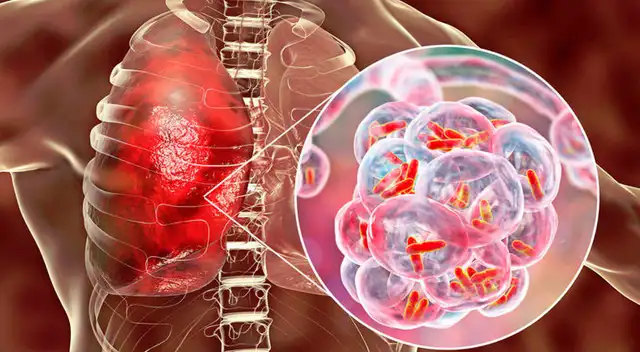 Garantizan especialistas cabaiguanenses control de la tuberculosis en el municipio (+ Audio)