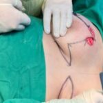 Sancti Spíritus: Demuestra efectividad cirugía oncoplástica en espirituanas con cáncer de mama