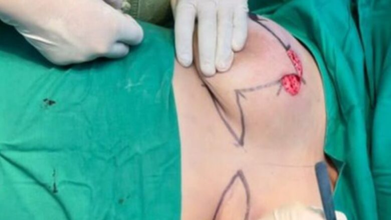 Sancti Spíritus: Demuestra efectividad cirugía oncoplástica en espirituanas con cáncer de mama